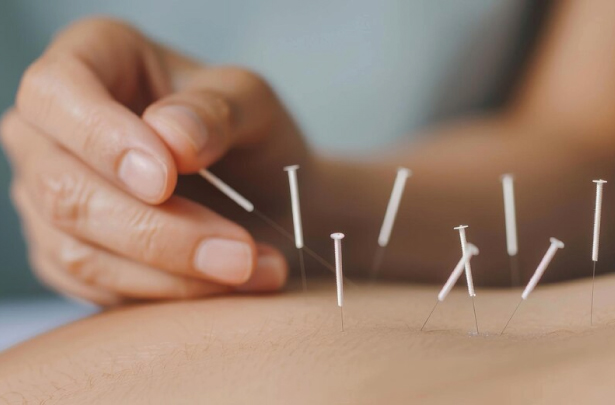 Acupuncture treatement HealMe