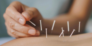 Acupuncture treatement in Melbourne