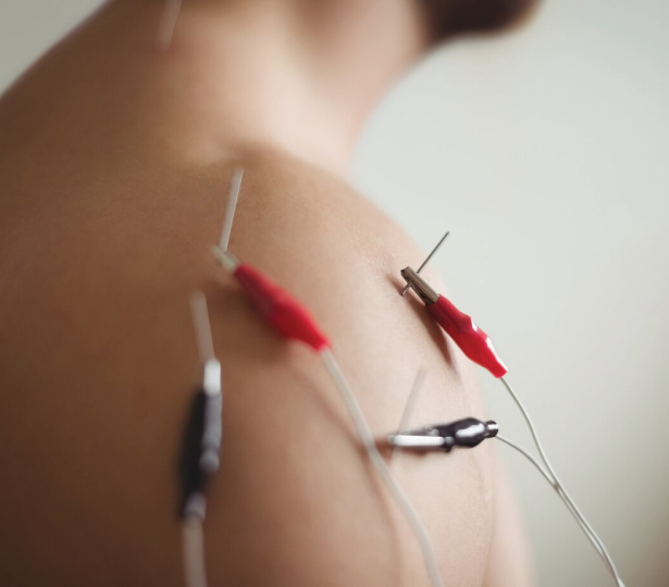 Acupuncture vs dry needling - HealMe