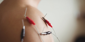 Acupuncture vs dry needling in Melbourne